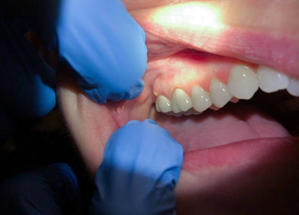 Best Tooth Infection Emergency Dentist  in Lowesville, NC